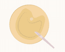 PCOS and Conception: Understanding Your Options